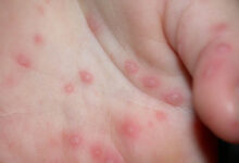 En las escuelas se mantendrán los filtros para detectar la enfermedad mano-pie-boca.