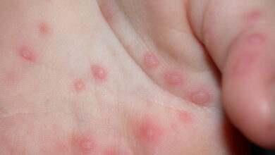 En las escuelas se mantendrán los filtros para detectar la enfermedad mano-pie-boca.