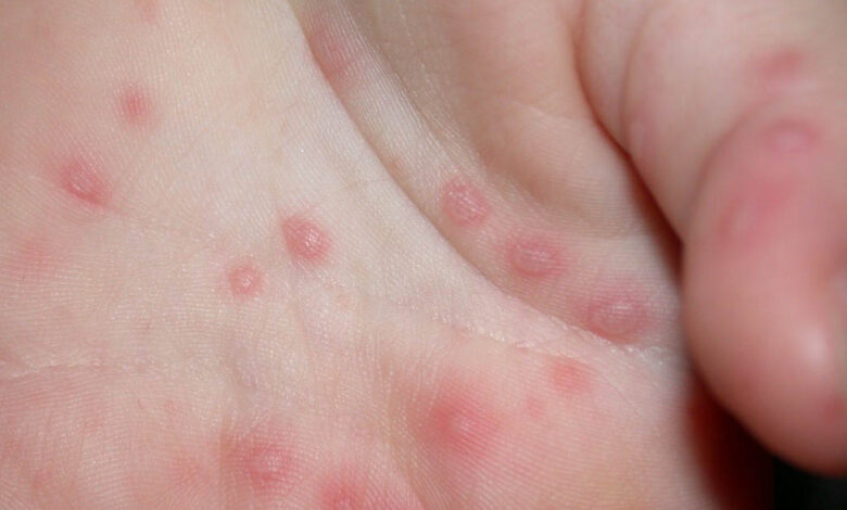 En las escuelas se mantendrán los filtros para detectar la enfermedad mano-pie-boca.