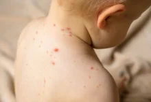 El Secretario de Salud descartó que en Tamaulipas exista una "emergencia" por casos de sarampión.