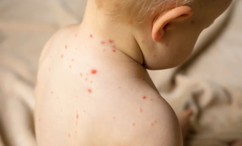 El Secretario de Salud descartó que en Tamaulipas exista una "emergencia" por casos de sarampión.